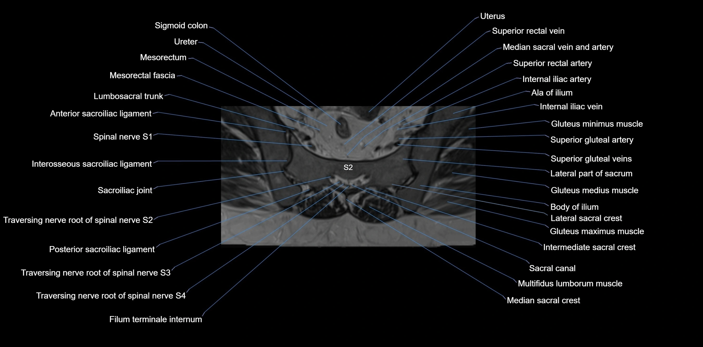MRI sacrum, coccyx and sacroiliac joint axial cross sectional anatomy 3T  radiology  image-img-00001-00028.webp